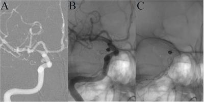 Endovascular Treatment of Tiny Aneurysms With Low-Profile Visualized Intraluminal Support Devices Using a “Compressed” Stent Technique